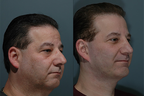 Male Facial Rejuvenation Before & After Image