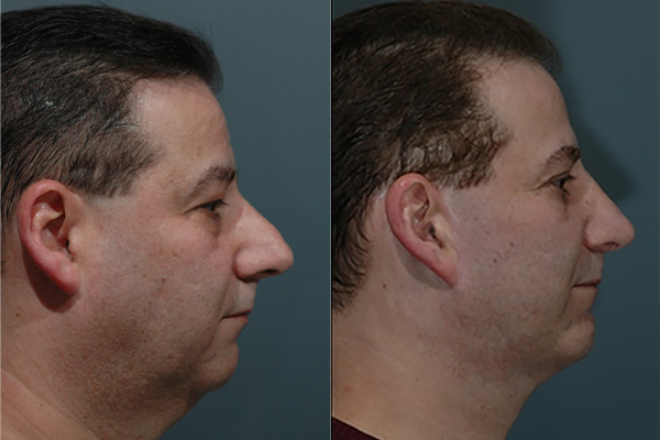 Male Facial Rejuvenation Before & After Image