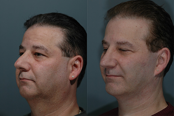 Male Facial Rejuvenation Before & After Image