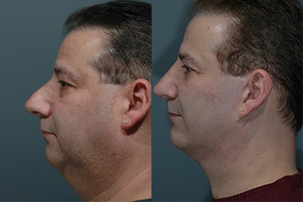 Male Facial Rejuvenation Before & After Image