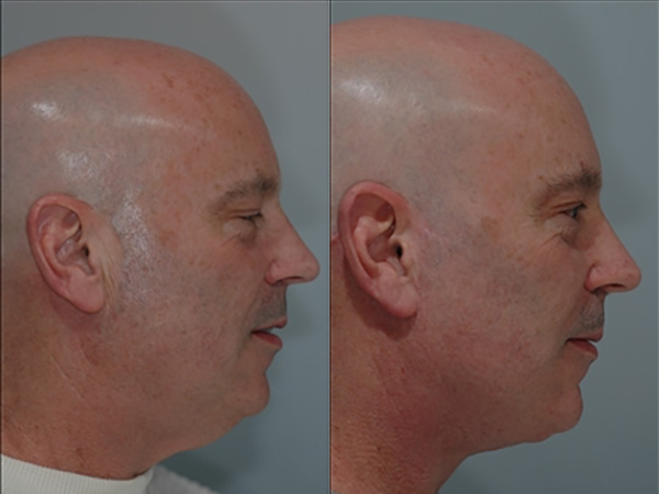 Male Facial Rejuvenation Before & After Image