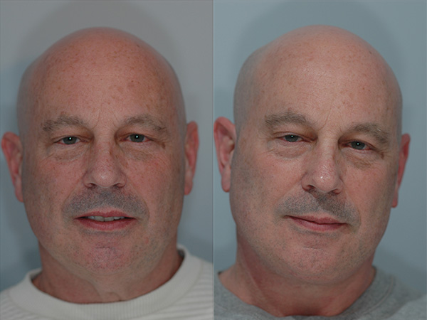 Male Facial Rejuvenation Before & After Image