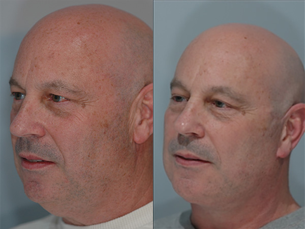 Male Facial Rejuvenation Before & After Image