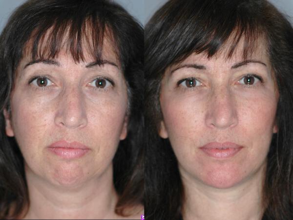 Chin Implant Before & After Image