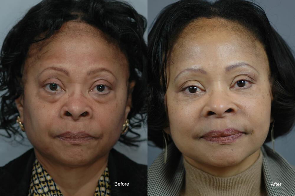 Facial Contouring Before & After Image