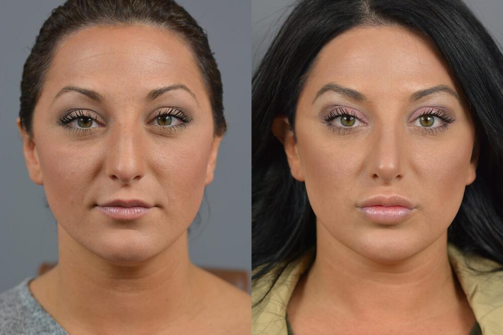 Nose Surgery Before & After Image