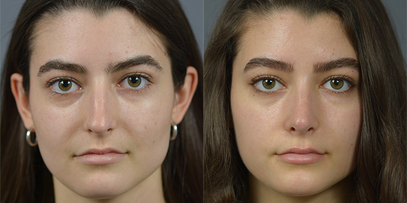 Nose Surgery Before & After Image