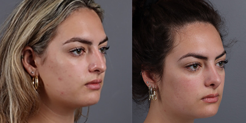 Nose Surgery Before & After Image