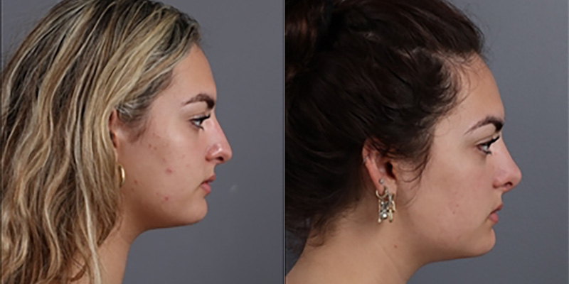 Nose Surgery Before & After Image