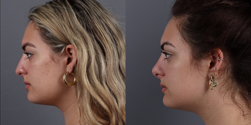 Nose Surgery Before & After Image