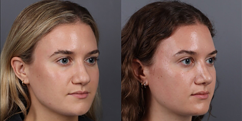 Nose Surgery Before & After Image