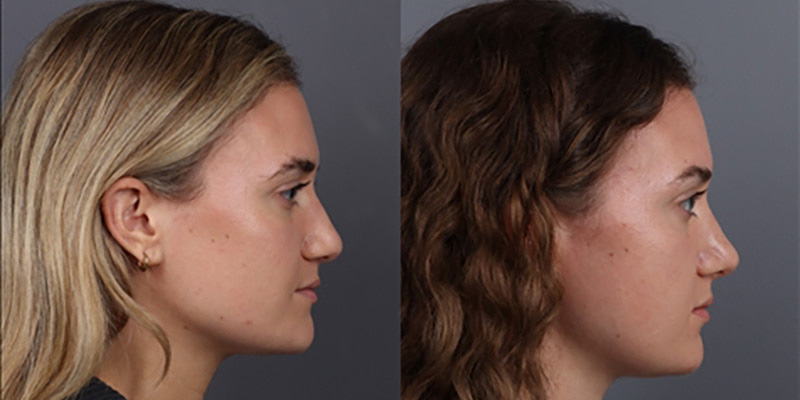 Nose Surgery Before & After Image