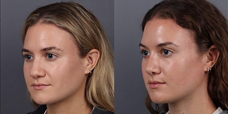 Nose Surgery Before & After Image