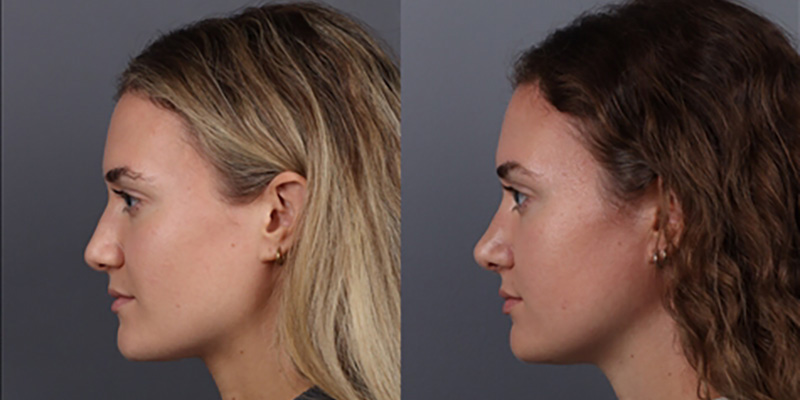 Nose Surgery Before & After Image