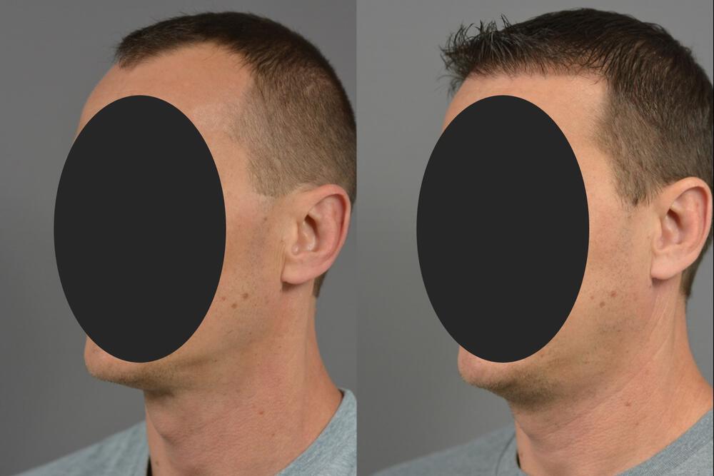 Hair Transplants Before & After Image