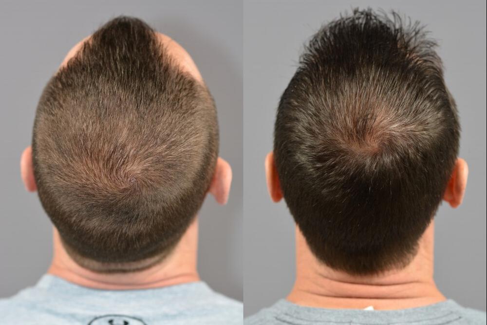 Hair Transplants Before & After Image