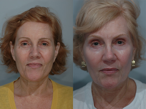 Chemical Peels Before & After Image