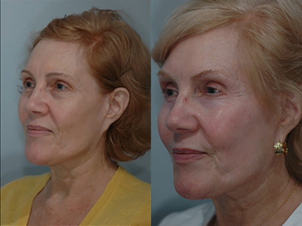 Chemical Peels Before & After Image