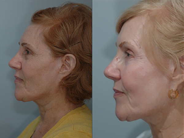 Chemical Peels Before & After Image