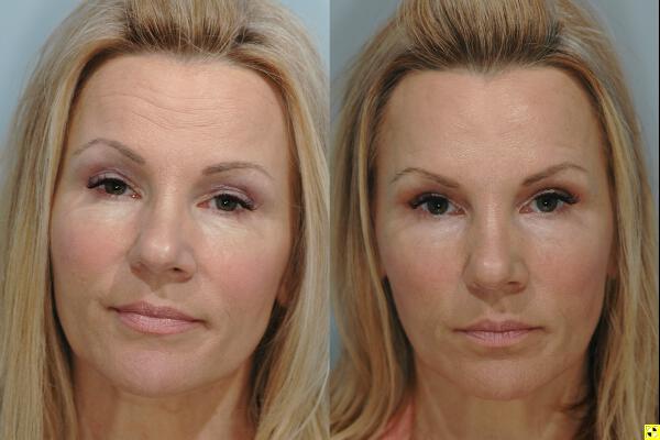 Injectables Before & After Image