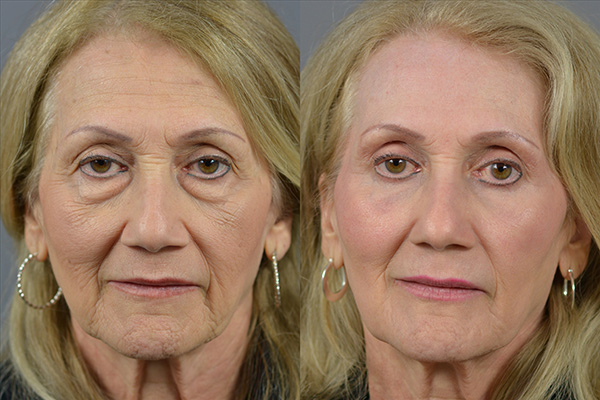 Laser Resurfacing Before & After Image