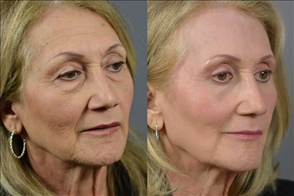 Laser Resurfacing Before & After Image