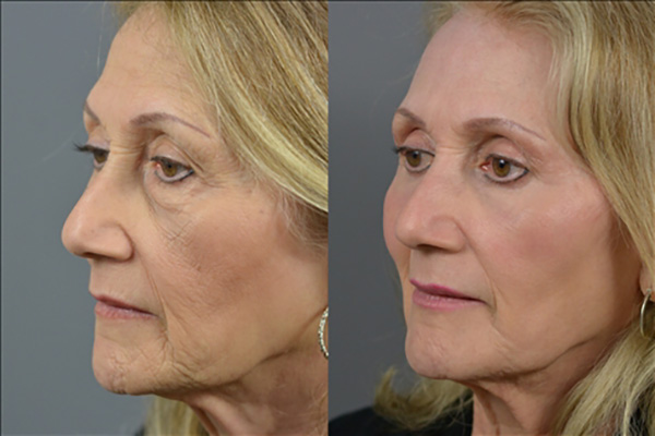 Laser Resurfacing Before & After Image